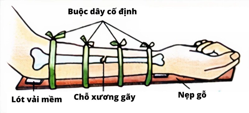 Sơ Cứu Gãy Xương Cẳng Tay
